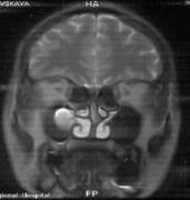 Киста правой верхнечелюстной пазухи, лечение лазером Милон-Лахта(МРТ черепа)