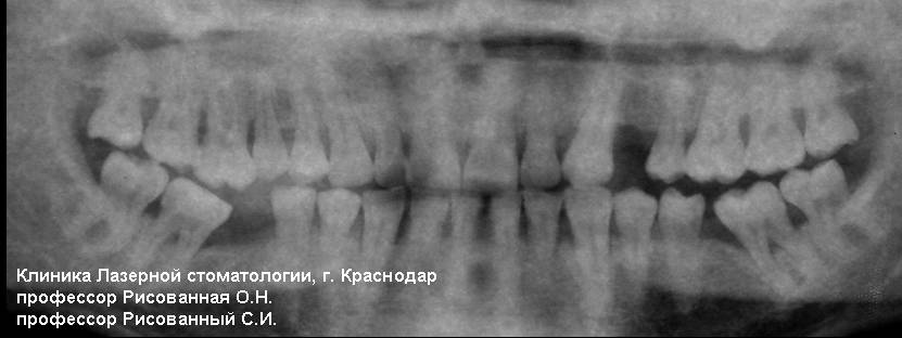 Ортопантомограмма через два года после лечения, фотосенсибилизатор радахлорин, лазерный аппарат ЛАХТА-МИЛОН