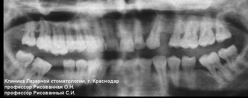 Пародонтит, ортопантомограмма до лечения