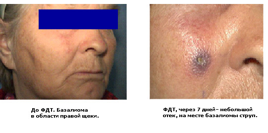 Фотодинамическая терапия базалиомы, лазерный аппарат ЛАХТА-МИЛОН, радахлорин