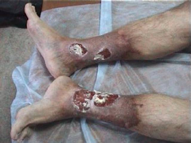 трофические язвы голени